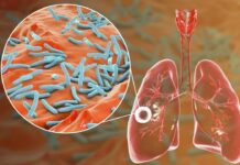 Desarrollan una estrategia innovadora para acortar tratamiento contra la tuberculosis
