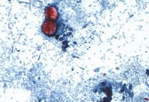 Ciclosporiasis: Primeras muertes registradas en EE.UU. en medio de un brote alarmante