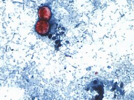 Ciclosporiasis: Primeras muertes registradas en EE.UU. en medio de un brote alarmante