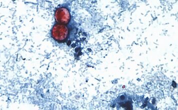 Ciclosporiasis: Primeras muertes registradas en EE.UU. en medio de un brote alarmante