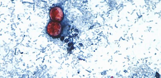 Ciclosporiasis: Primeras muertes registradas en EE.UU. en medio de un brote alarmante