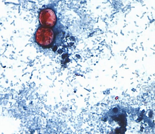 Ciclosporiasis: Primeras muertes registradas en EE.UU. en medio de un brote alarmante