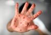 Aumentan los casos de Mpox en el país: 15 confirmados en lo que va del año