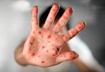 Aumentan los casos de Mpox en el país: 15 confirmados en lo que va del año