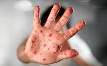 Aumentan los casos de Mpox en el país: 15 confirmados en lo que va del año