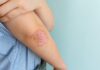 Campaña Gratuita para la Detección de la Enfermedad Psoriásica: Todo lo que Necesitas Saber