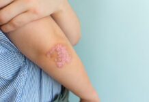 Campaña Gratuita para la Detección de la Enfermedad Psoriásica: Todo lo que Necesitas Saber