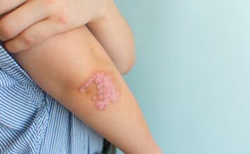 Campaña Gratuita para la Detección de la Enfermedad Psoriásica: Todo lo que Necesitas Saber