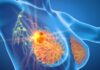 Cáncer de mama: Importancia de la mamografía temprana y antecedentes familiares