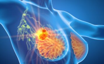 Cáncer de mama: Importancia de la mamografía temprana y antecedentes familiares